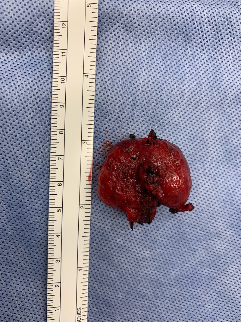 Illustration for article titled Tumor take out - update